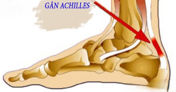 Viêm gân Achilles